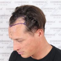 Side photo of Football player Denis Toplak before his hair transplant in Turkey at Cosmedica Clinic