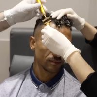 Portuguese football player Nani during his hair treatment at Cosmedica Clinic with Dr Levent Acar