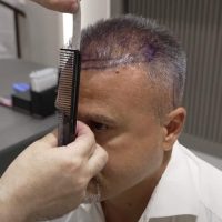 Former football Player Mustafa Kocabey during his hair treatment at Cosmedica Clinic