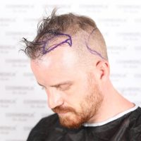 Actor Robert Kazinsky before his hair transplant in Turkey at Cosmedica Clinic