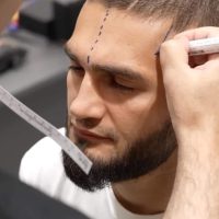 Photo of Hair analysis of Professional MMA Fighter Rustam Serbiev at Cosmedica Clinic