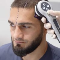 Professional MMA Fighter Rustam Serbiev during hi hair analysis at Cosmedica Clinic