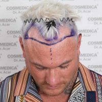 Image of Thomas Powell before his hair transplant at Cosmedica Clinic