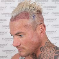 Picture of Thomas Powell before his hair transplant at Cosmedica Clinic