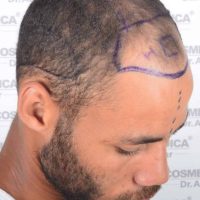 Photo of English professional boxer Troy Williamson before his hair transplant at Cosmedica Clinic