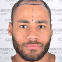 Image of English professional boxer Troy Williamson before his hair transplant at Cosmedica Clinic