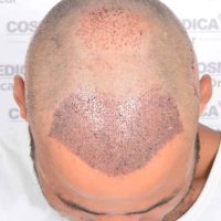 English professional boxer Troy Williamson right after his hair transplant at Cosmedica Clinic