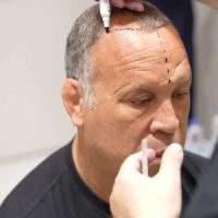 Professional MMA fighter Wanderlei Silva during his hair transplant consultation at Cosmedica Clinic with Dr Levent Acar