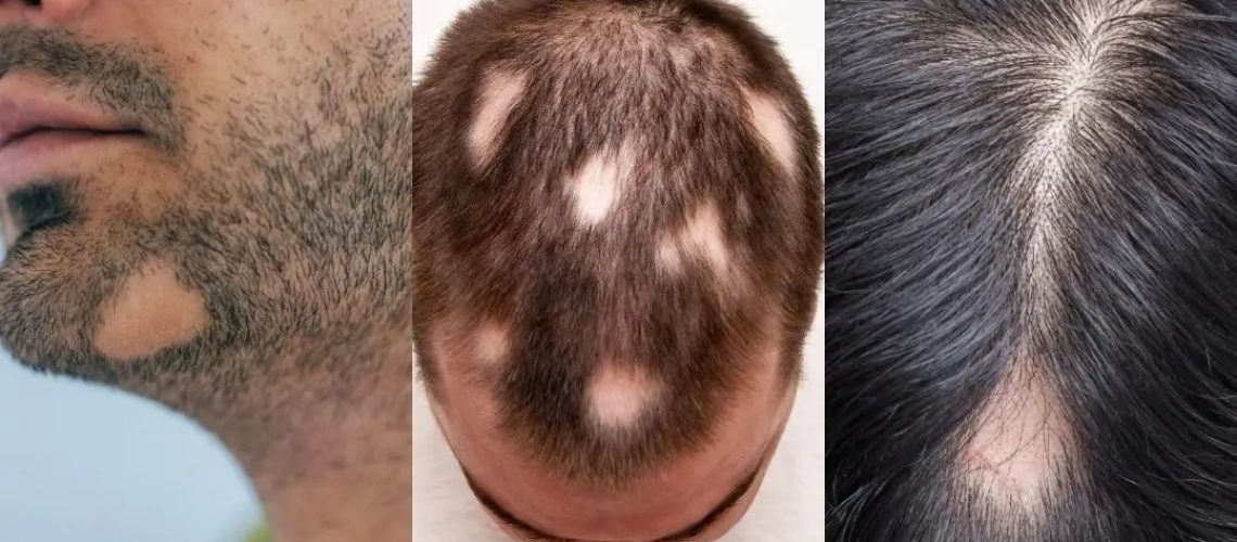alopecia-areata-cosmedica