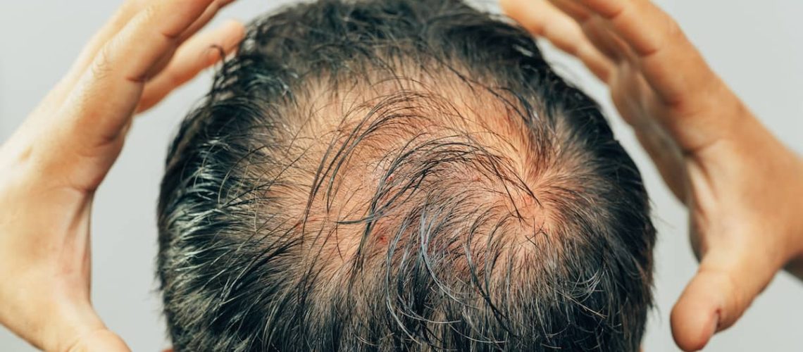 alopecie-androgenetique