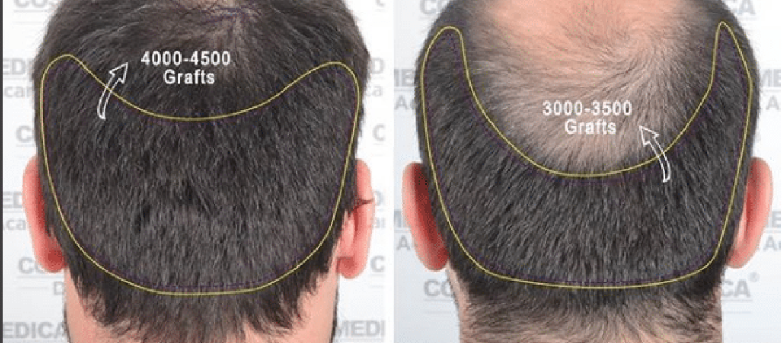 Crown Hair Transplants - Cosmedica