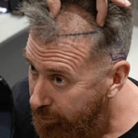 DJ Vlad during his hair transplant consultation at Cosmedica Cilnic with Dr. Levent Acar