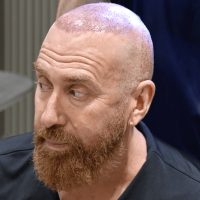 DJ Vlad right after his hair transplant at Cosmedica Clinic