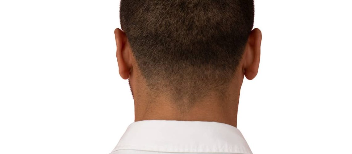 Hair transplant donor area of a man