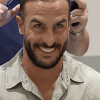 Portuguese singer Nininho during his hair transplant analysis with Dr Levent Acar at Cosmedica Clinic