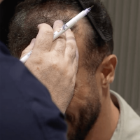 Portuguese singer Nininho during his hair transplant analysis at Cosmedica Clinic