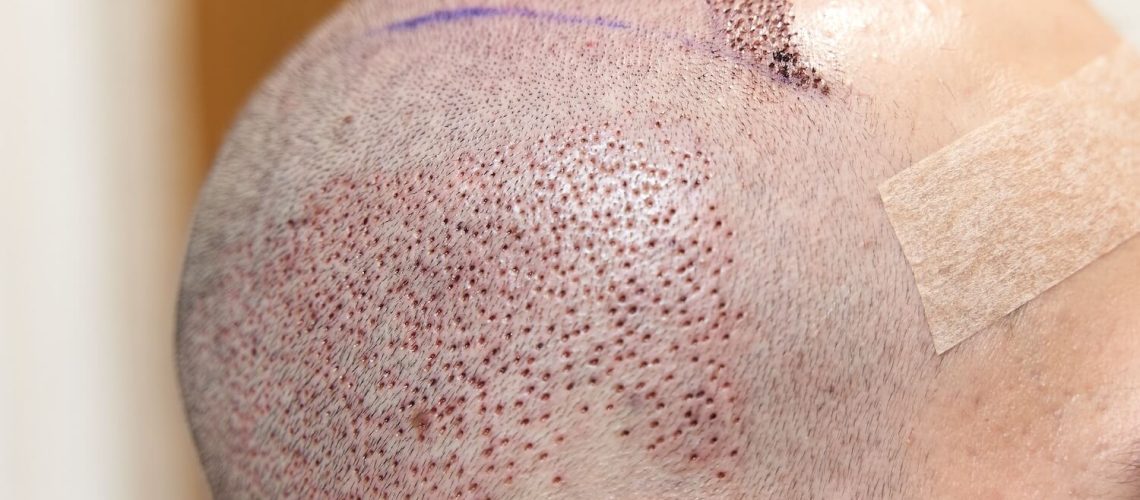 Side view of male scalp after hair transplant surgery