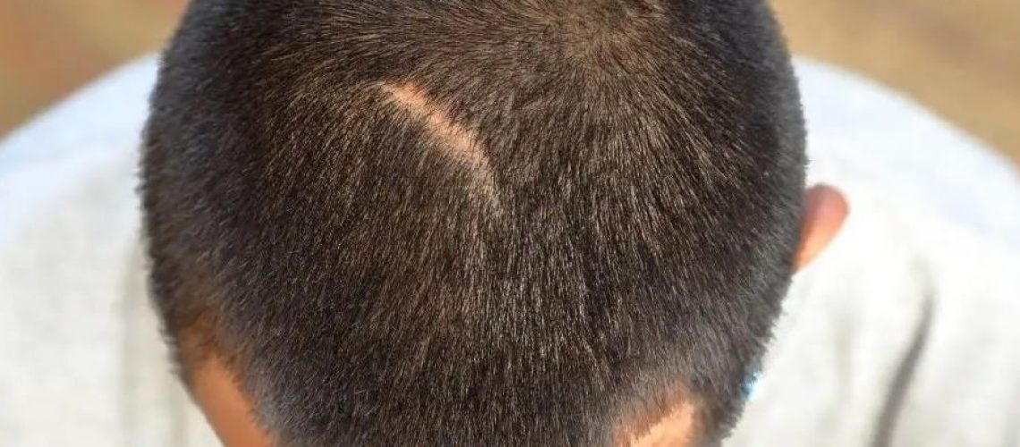 Przeszczep włosów: wszystko o bliznach po zabiegu