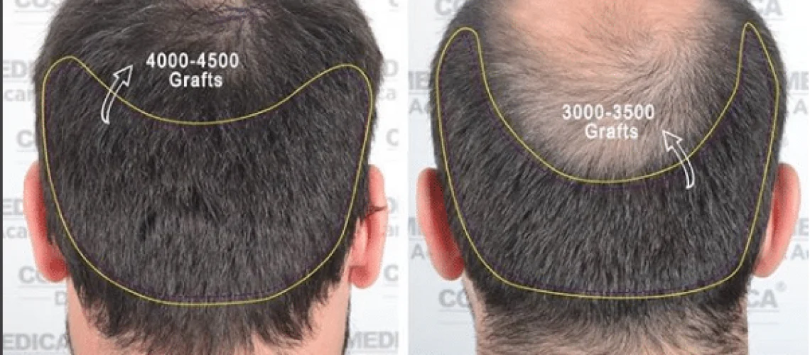 Мужчина до и после пересадки волос