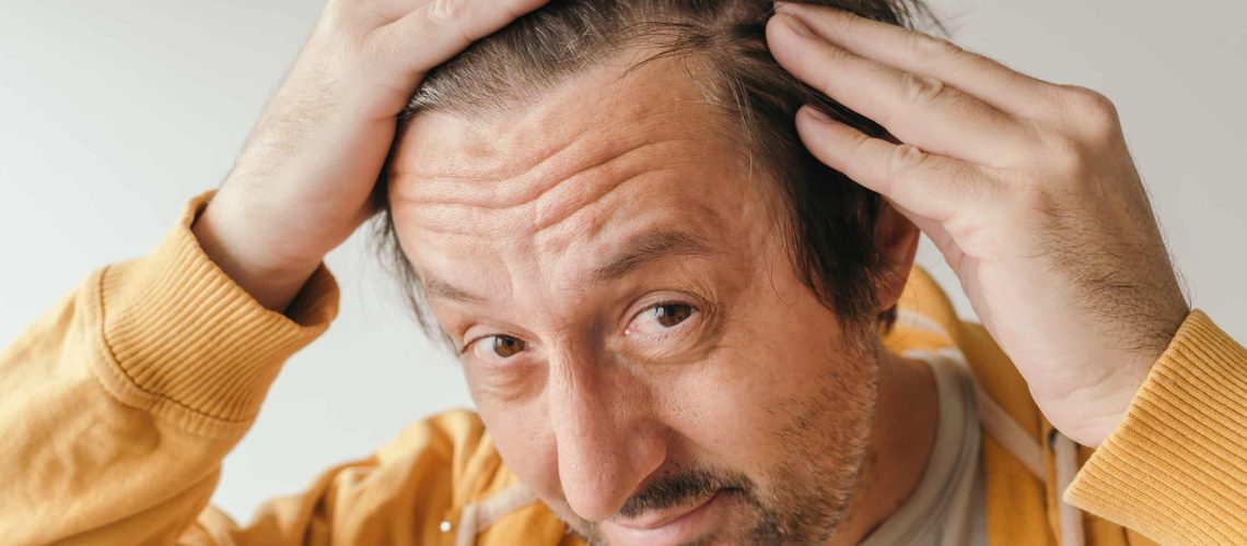 Мужчина с фронтальной фиброзной алопецией смотрит в зеркало, озабоченный потерей волос на лбу